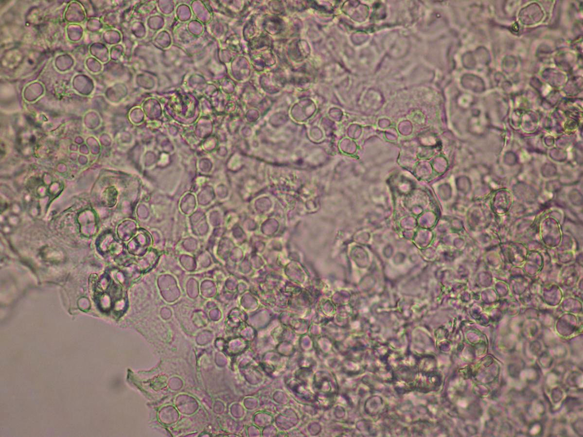 Epidermis de un anfibio infectado por Bd durante la llegada del hongo a El Cope, Panamá, 2004. Las células redondeadas pertenecen a Bd, mientras que las células más irregulares son parte de la piel del anfibio. Foto: Forrest Brem.